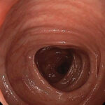 An up close image of a healthy colon from the view of a colonoscopy.