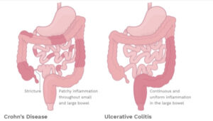 An image that compares inflammation in the intestinal tract in Crohn's disease versus inflammation in the intestinal tract of ulcerative colitis.