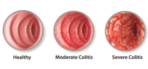 an image that compares a healthy colon to moderate and severe colitis