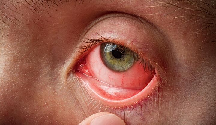 An up close image of the eyeball and eyelid that are red and inflamed.