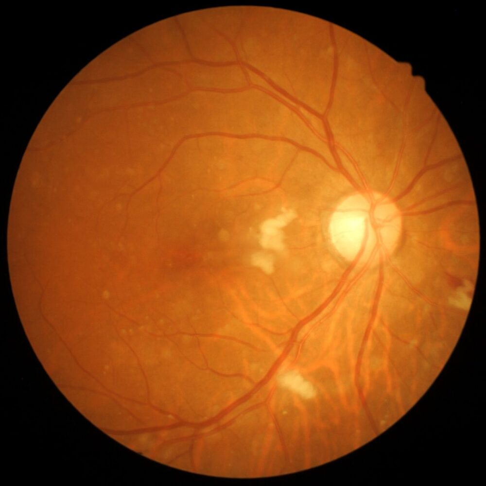 An up close image of a retinal scan of an eyeball.