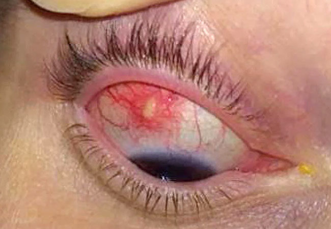 An up close image of the white part of the eyeball that is red and inflamed.