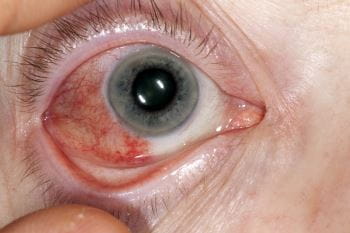 An up close image of an eyeball that has inflammation of the tissue.