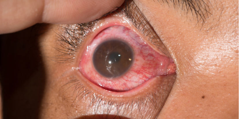 An up close image of an eyeball that is very red and inflamed.
