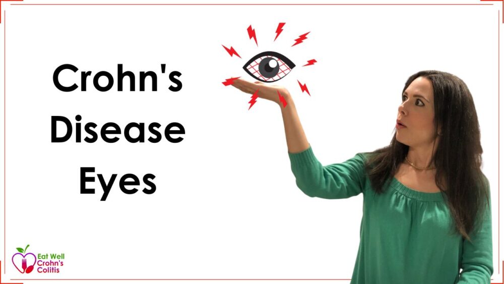 Crohn’s Disease Eyes: Symptoms, Complications, and Treatment